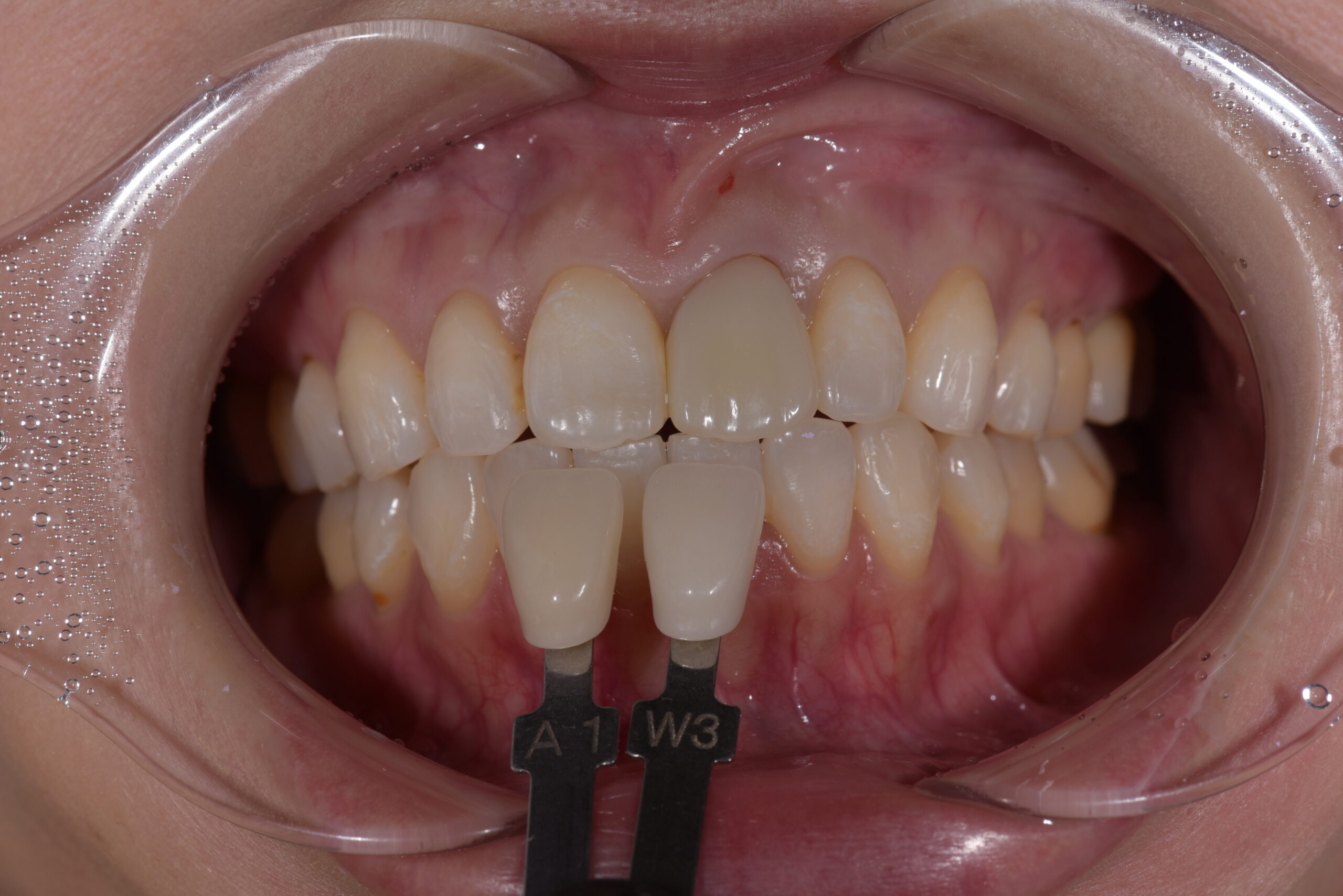 左上前歯ポーセレンフルジルコニア症例 image 1