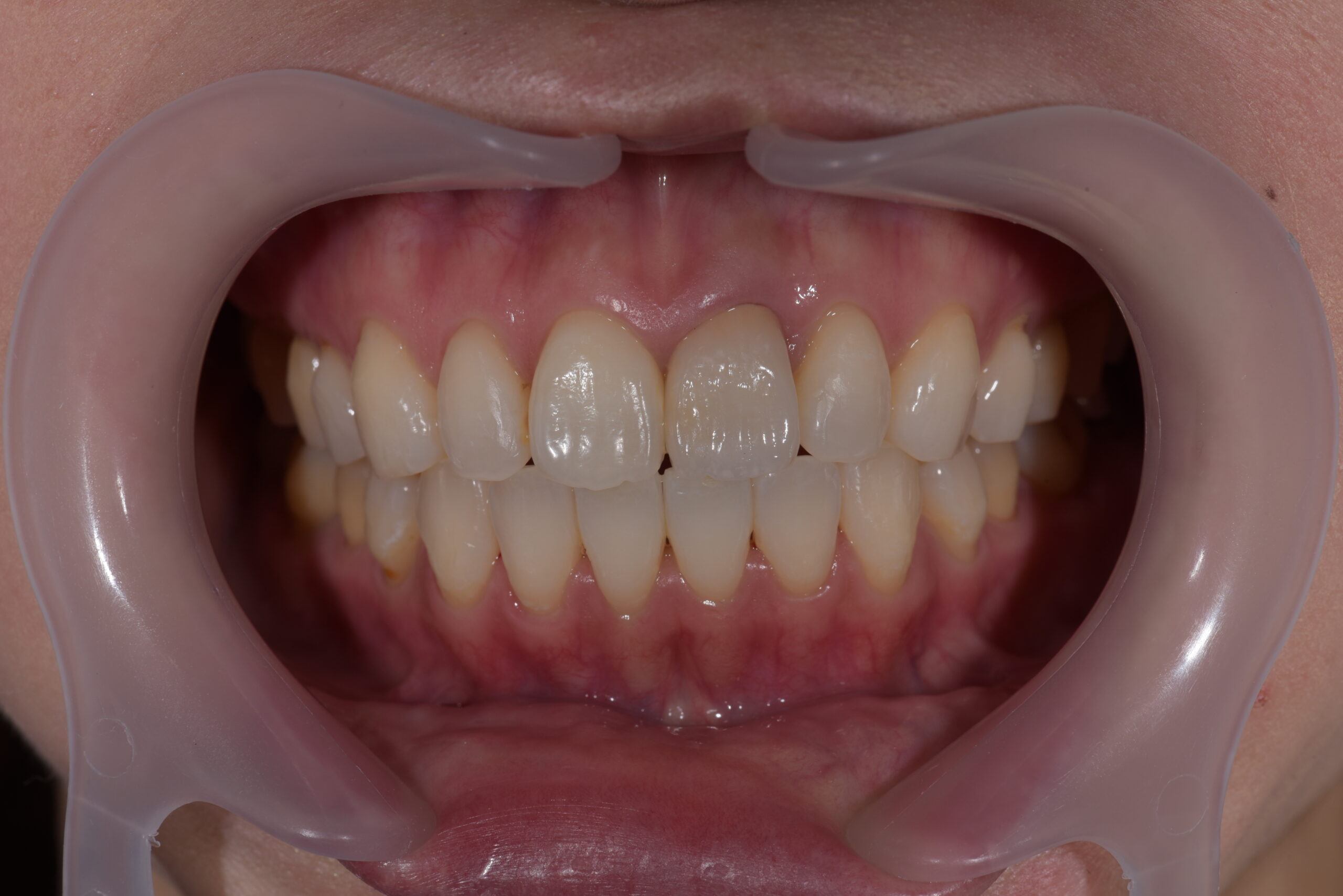 左上前歯ポーセレンフルジルコニア症例 image 2