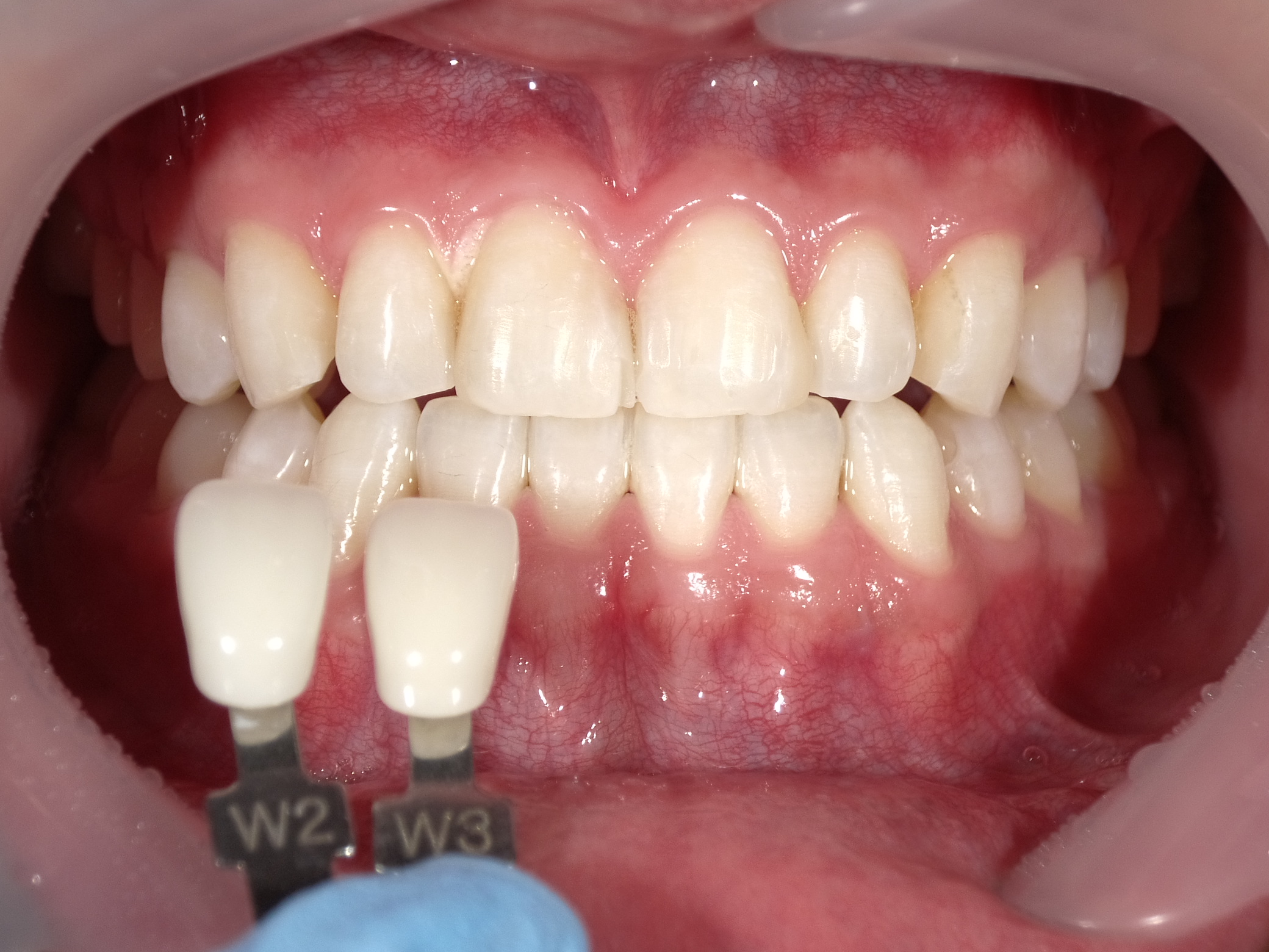 オフィスホワイトニング３回・ホームホワイトニング image 4