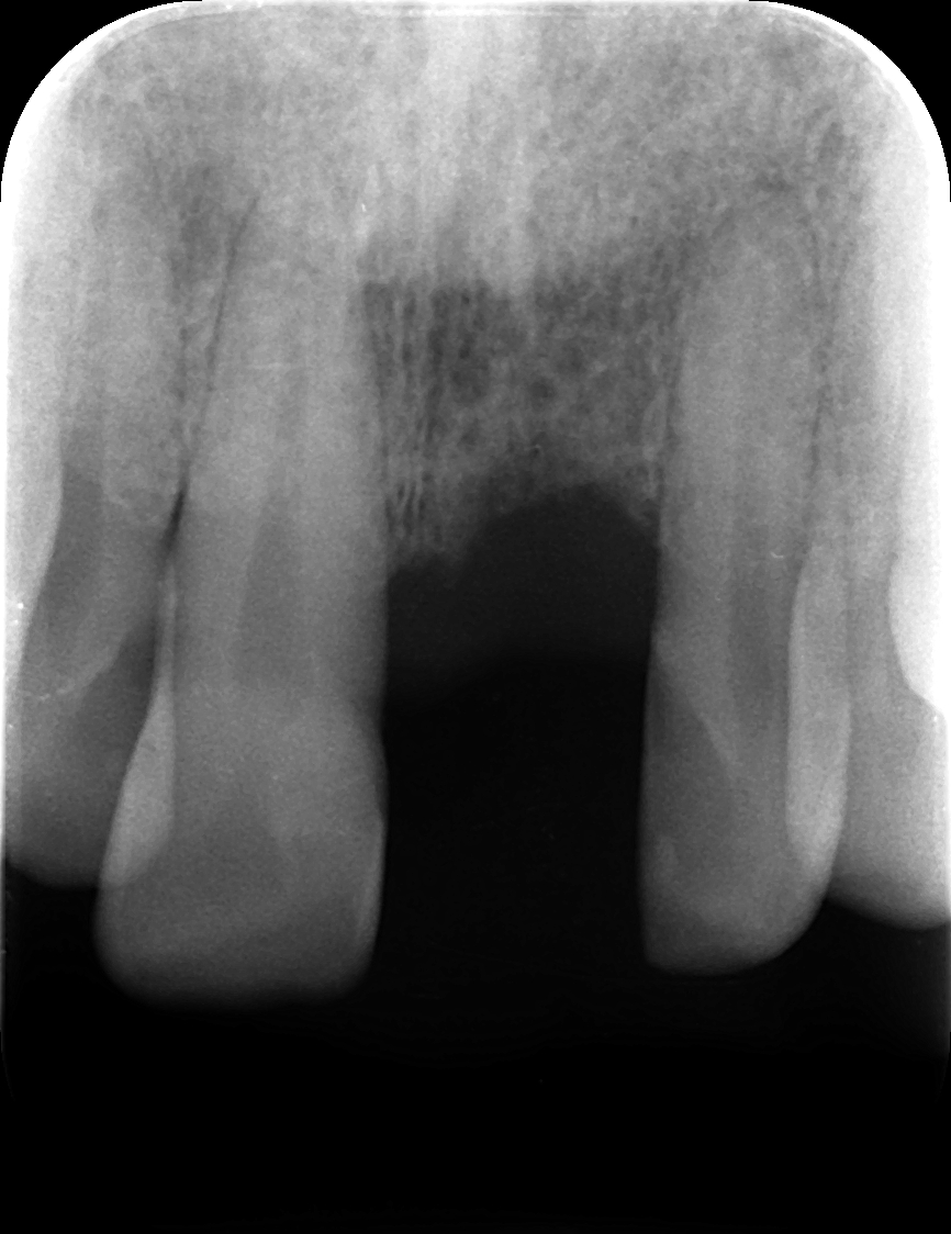 前歯インプラント症例 image 2