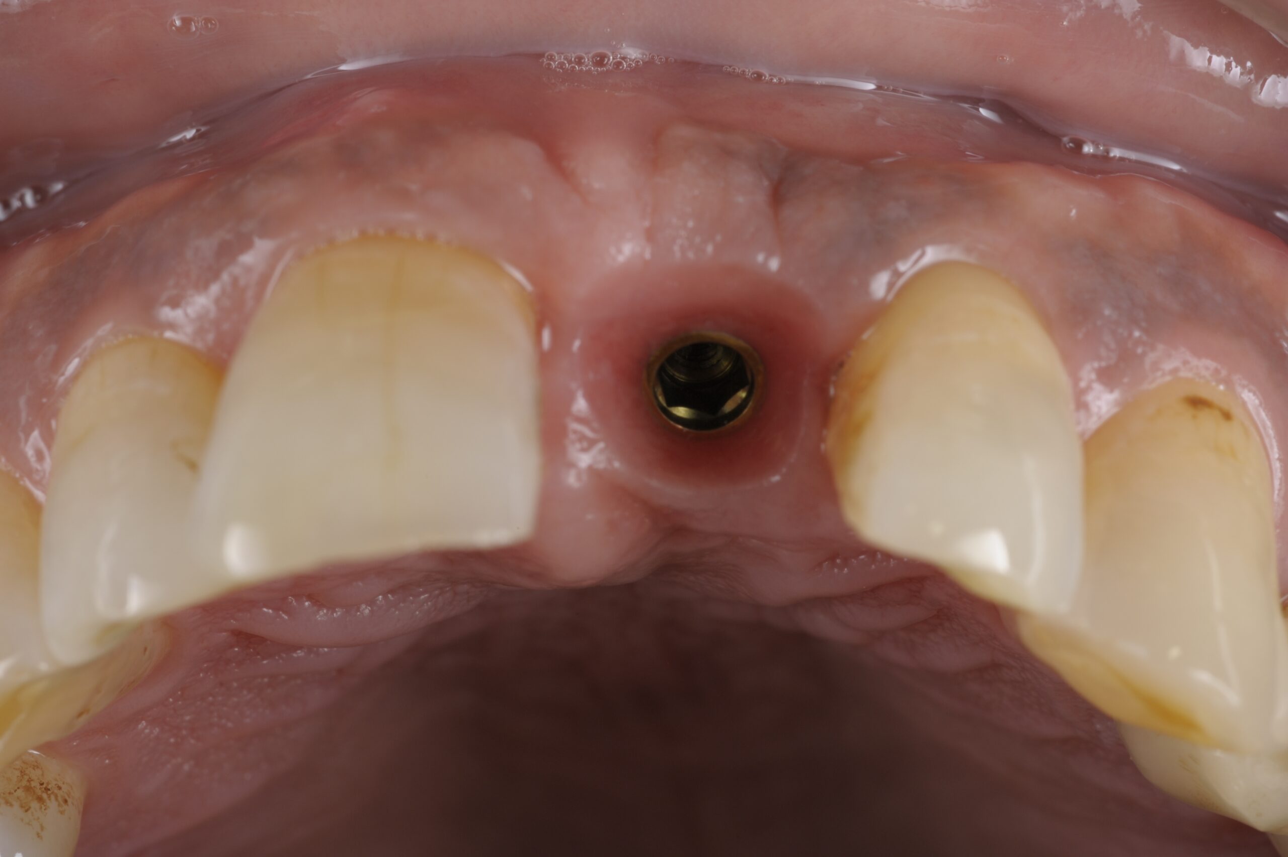 前歯インプラント症例 image 3