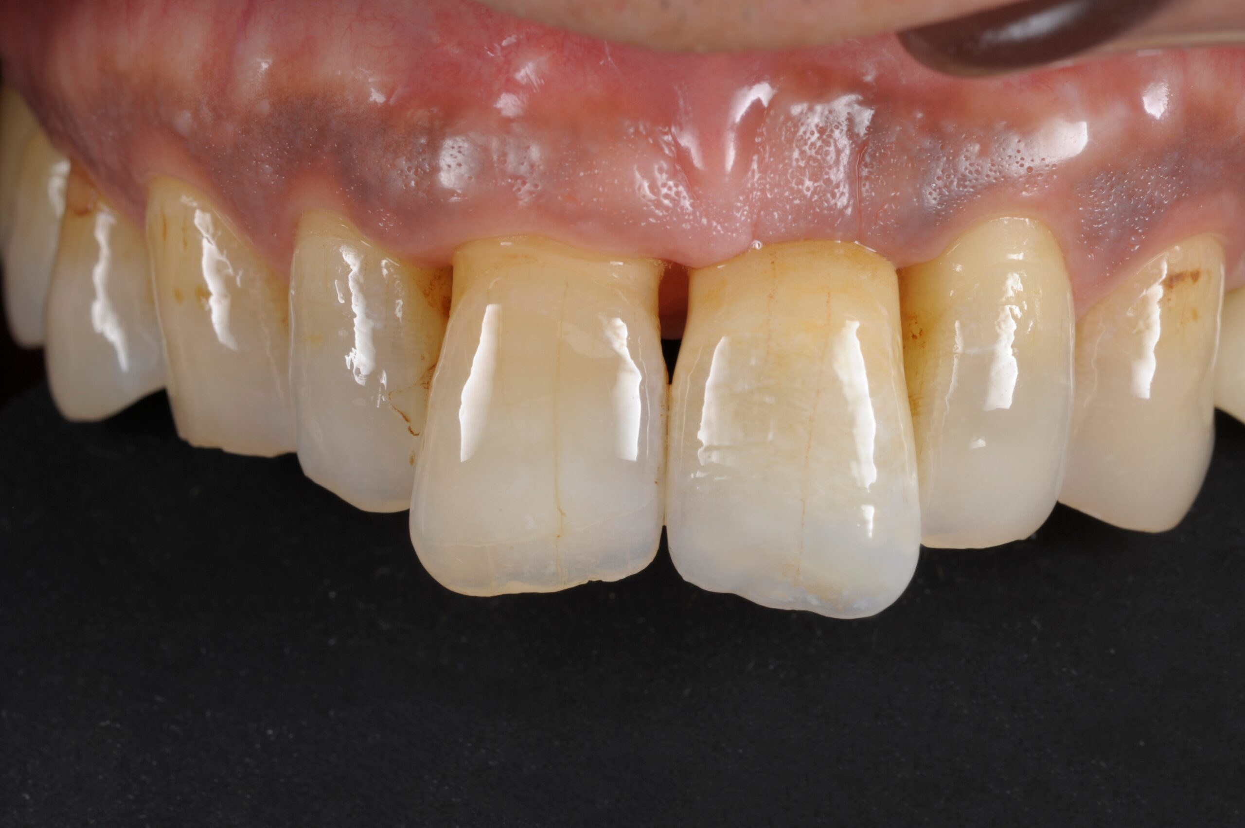 前歯インプラント症例 image 4