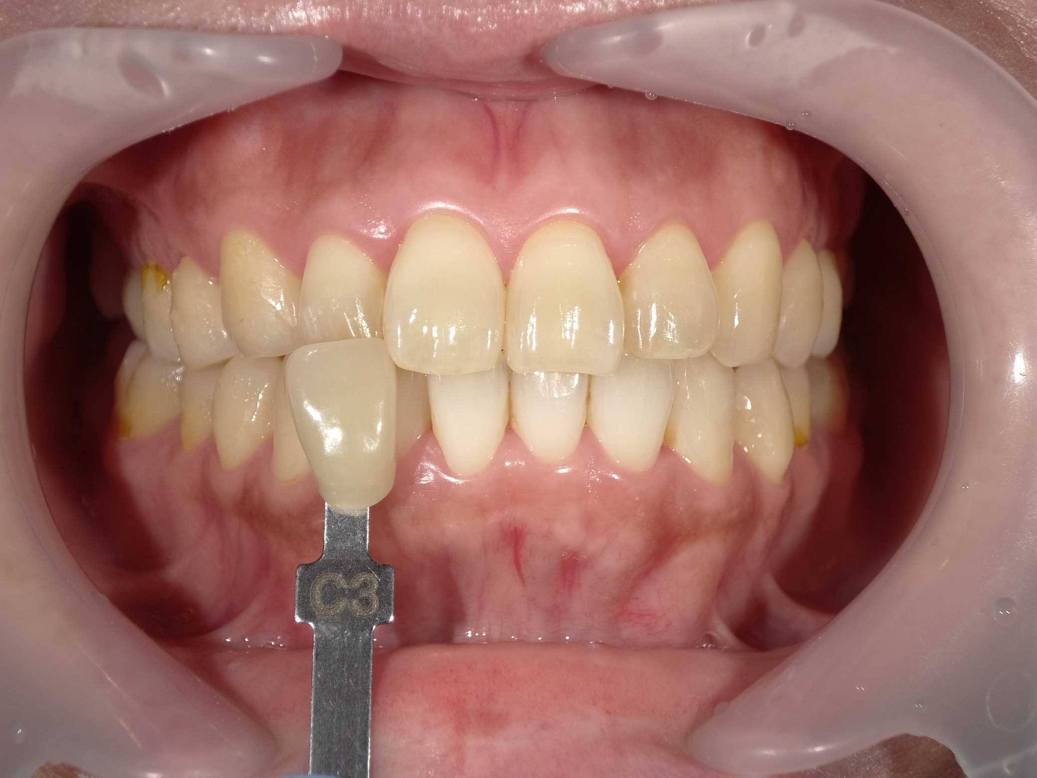 オフィスホワイトニング３回・ホームホワイトニング image 1