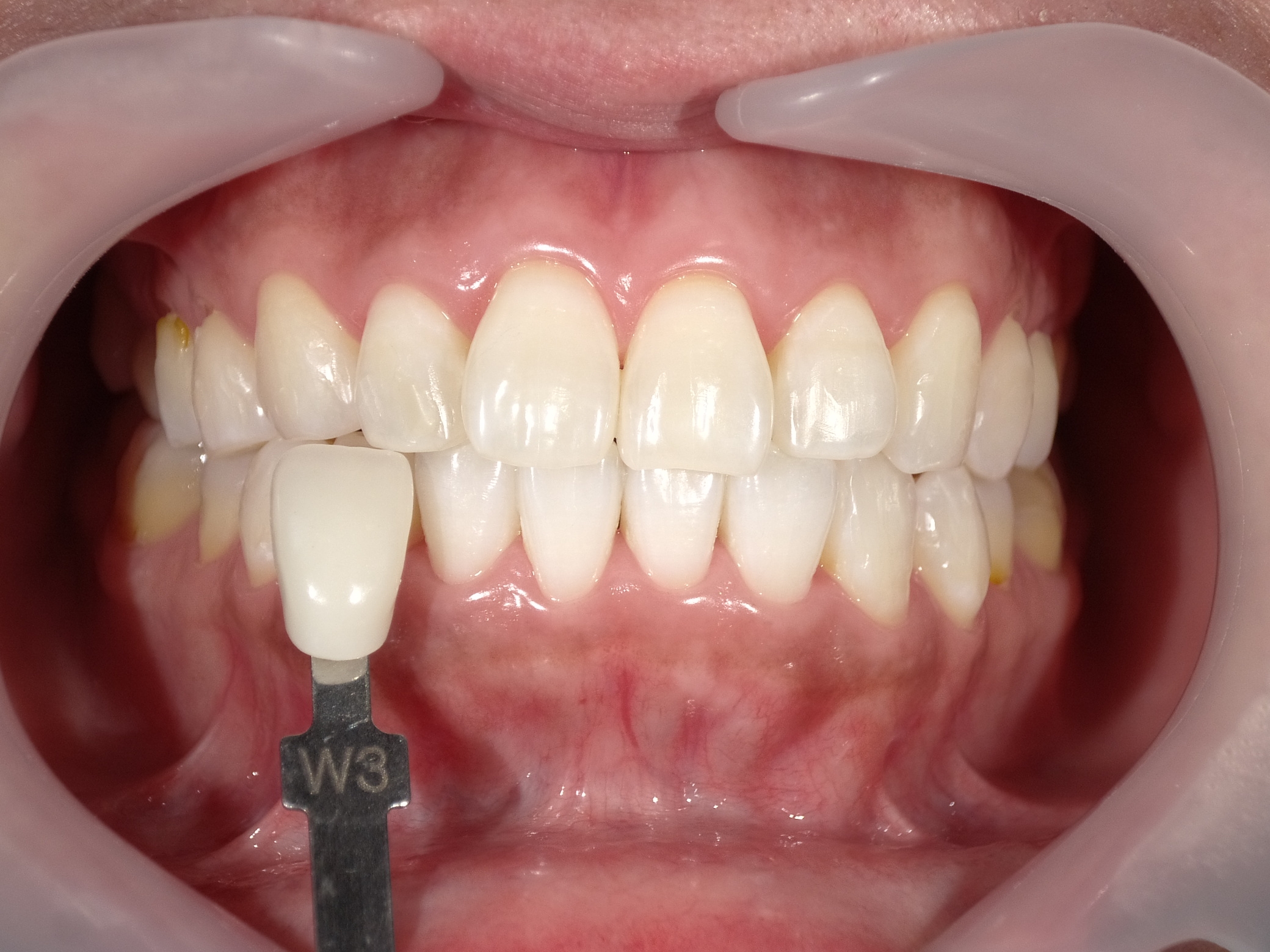 オフィスホワイトニング３回・ホームホワイトニング image 4