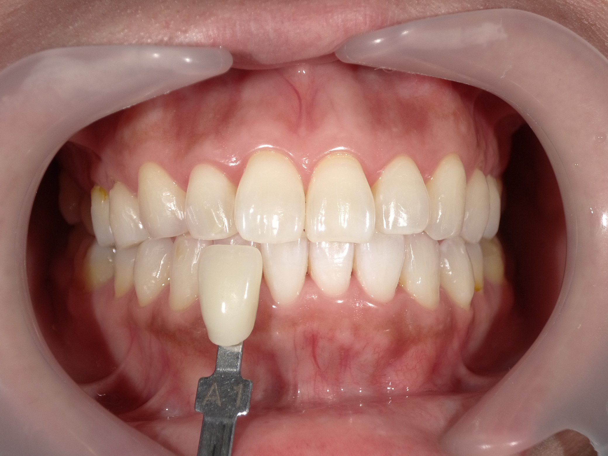 オフィスホワイトニング３回・ホームホワイトニング image 3