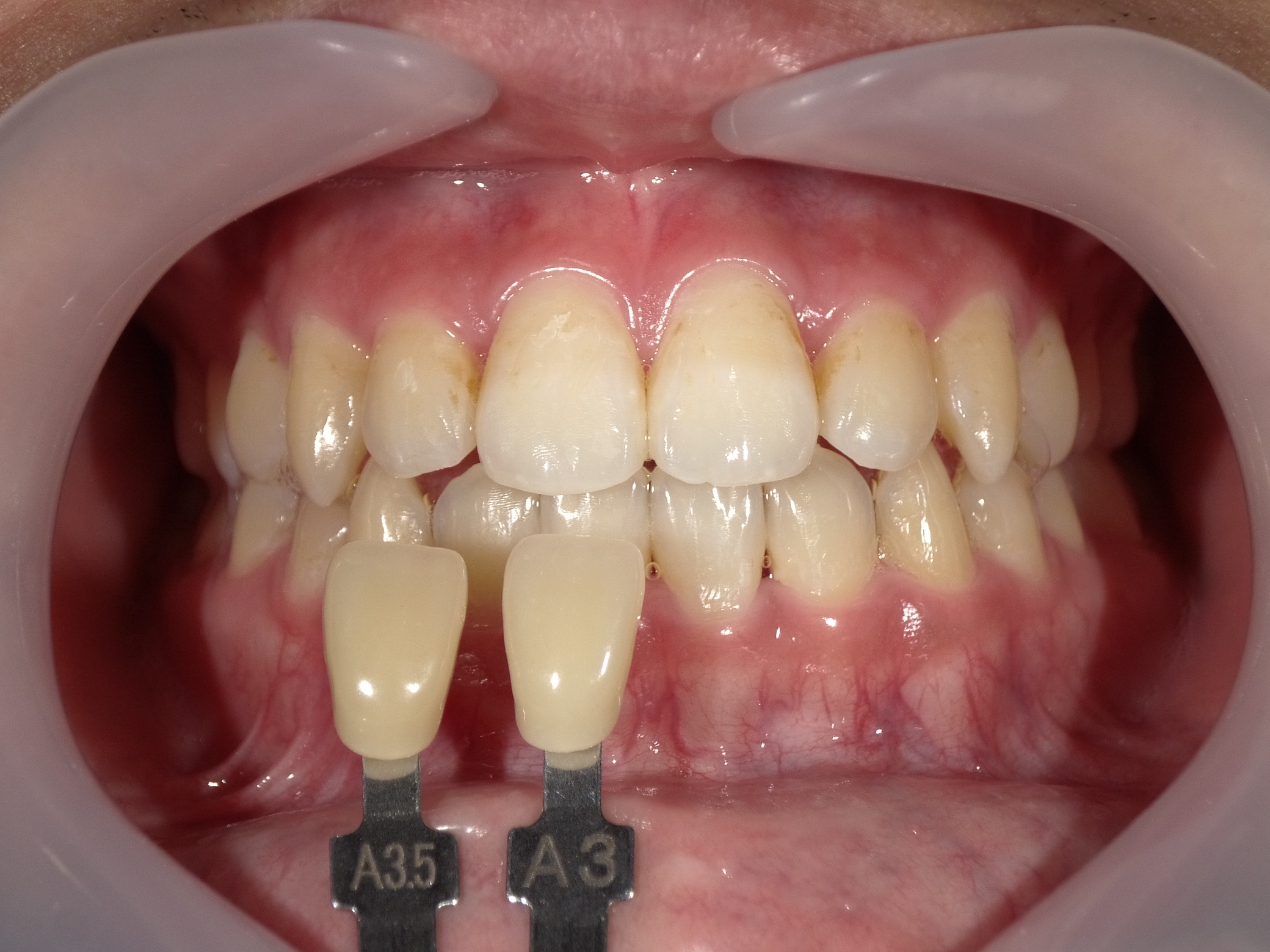 オフィスホワイトニング３回コース image 1