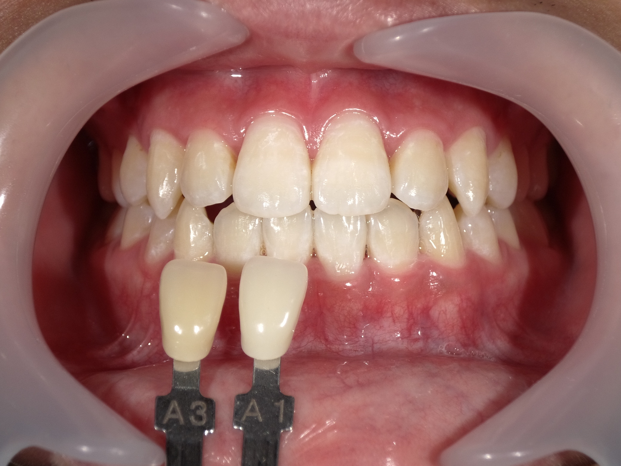 オフィスホワイトニング３回コース image 2