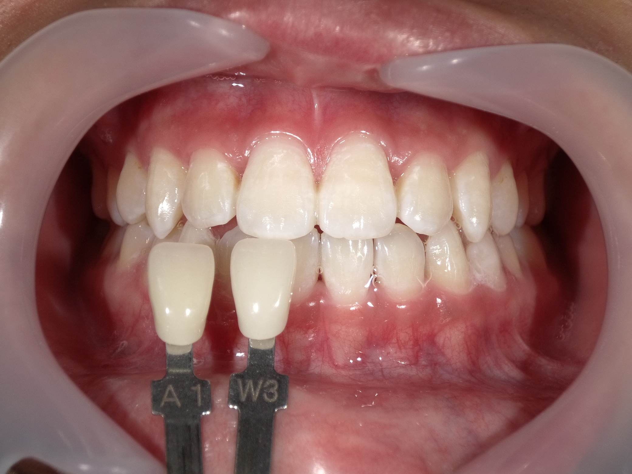 オフィスホワイトニング３回コース image 3