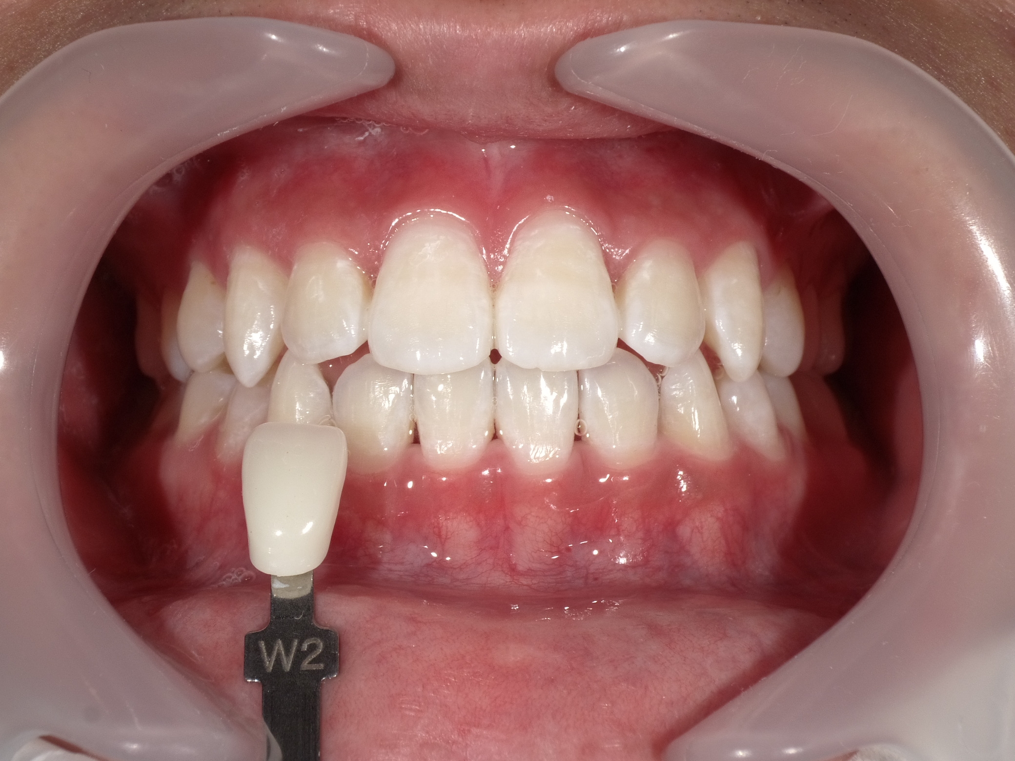 オフィスホワイトニング３回コース image 4