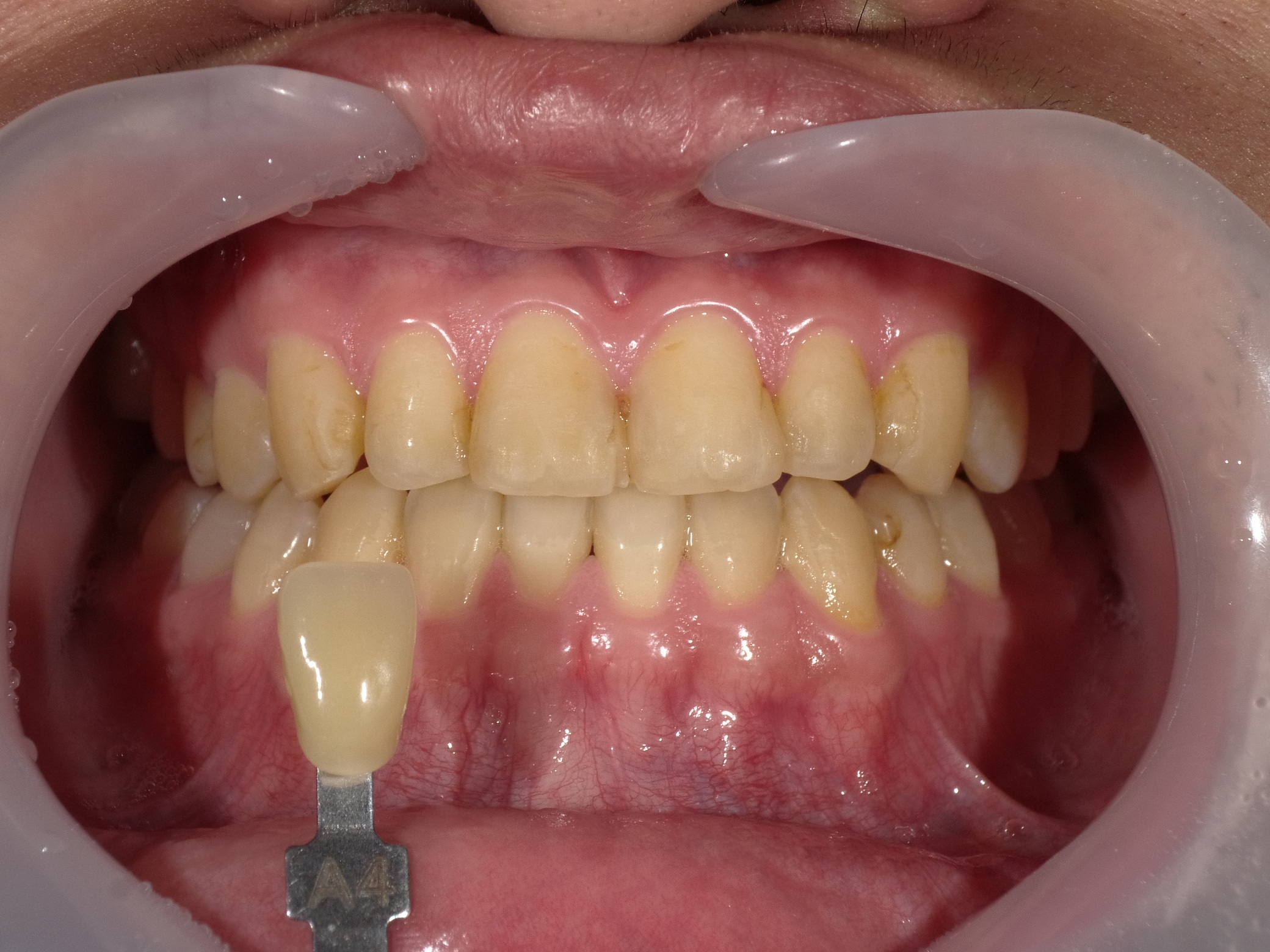 オフィスホワイトニング３回・ホームホワイトニング image 1