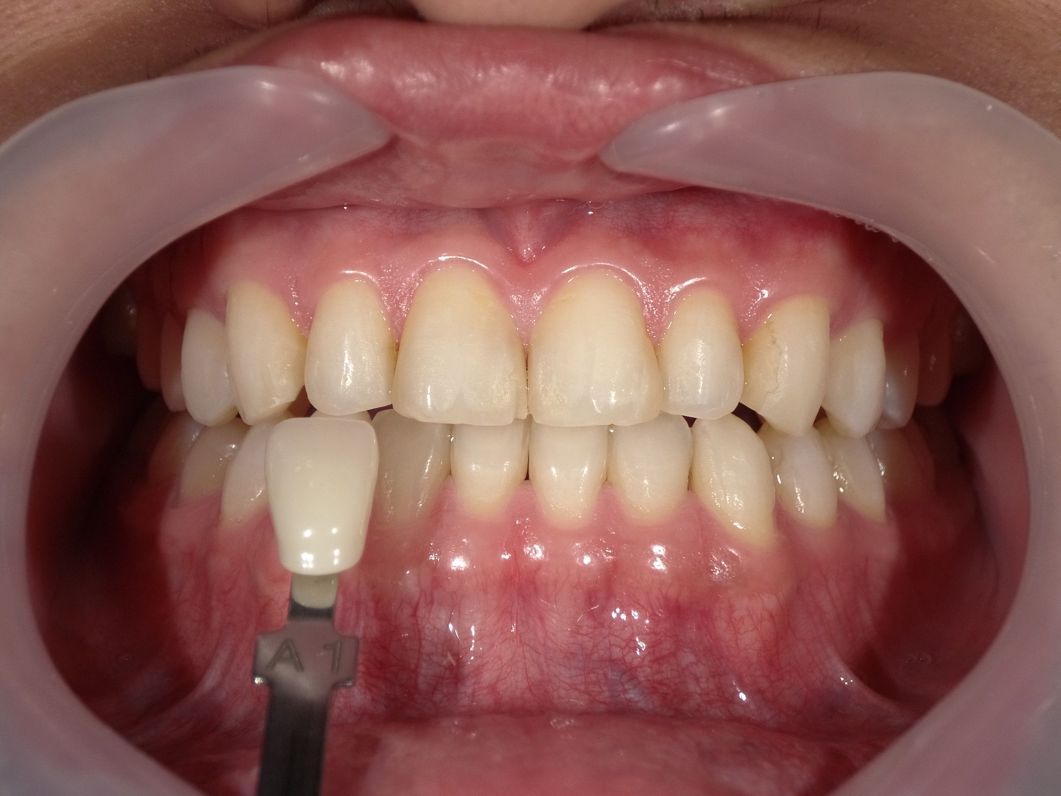 オフィスホワイトニング３回・ホームホワイトニング image 2