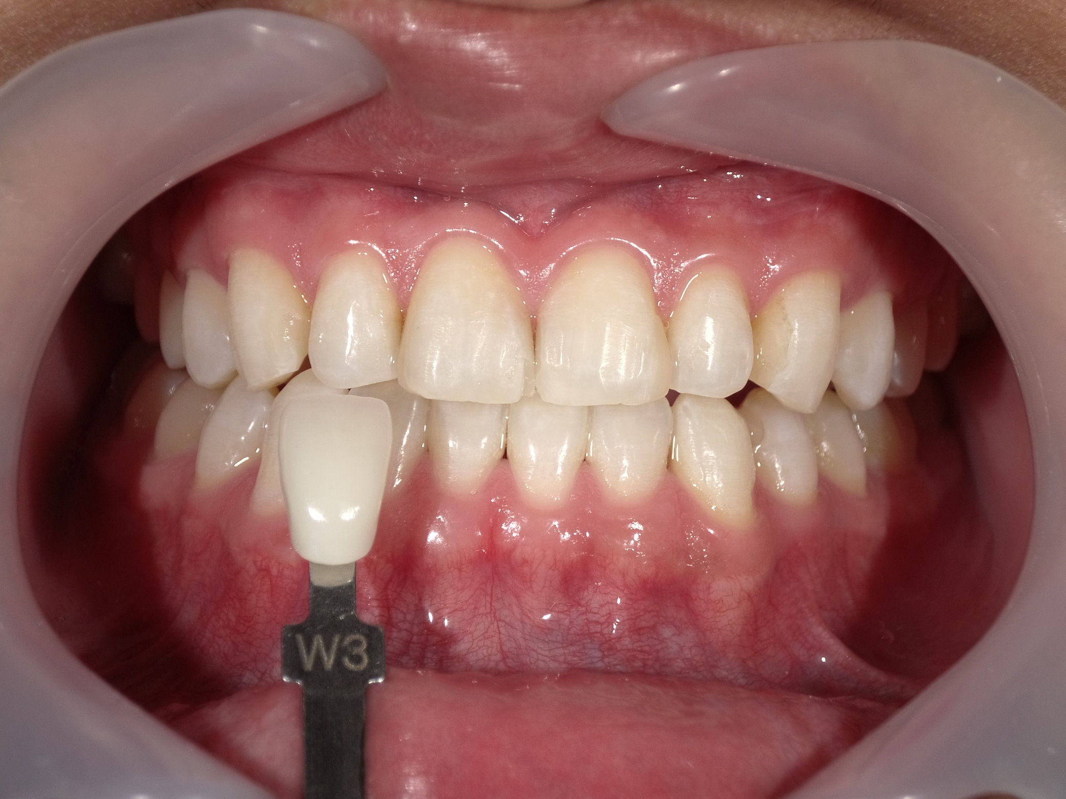 オフィスホワイトニング３回・ホームホワイトニング image 3