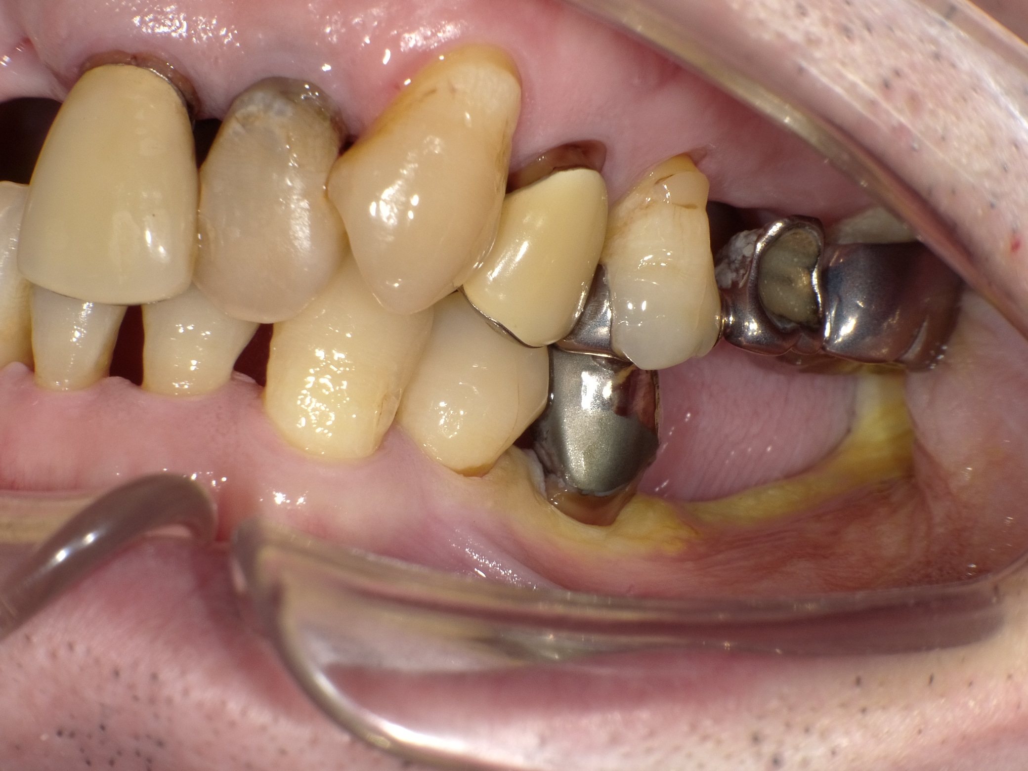 左下２本インプラント症例 image 1