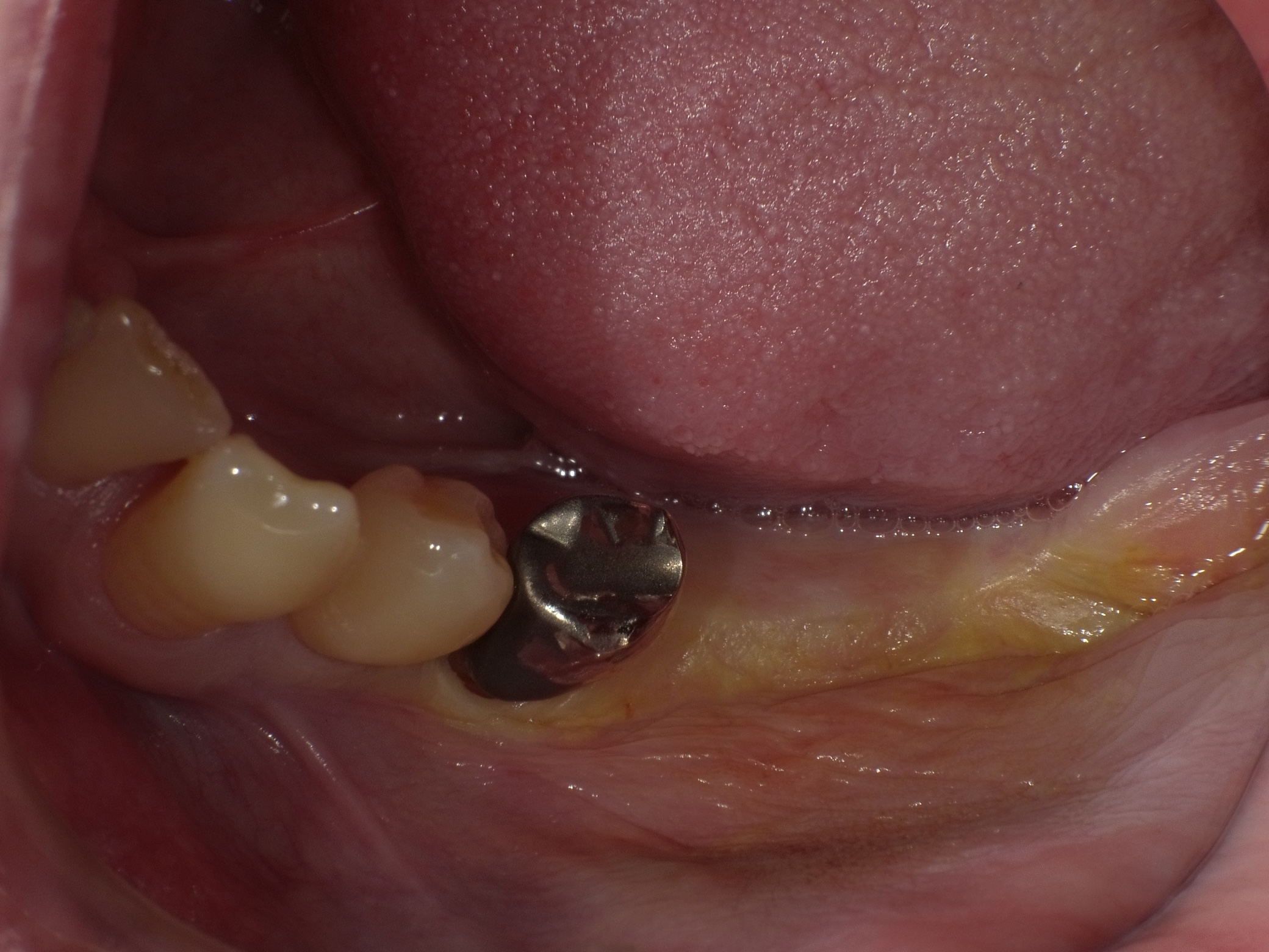 左下２本インプラント症例 image 2