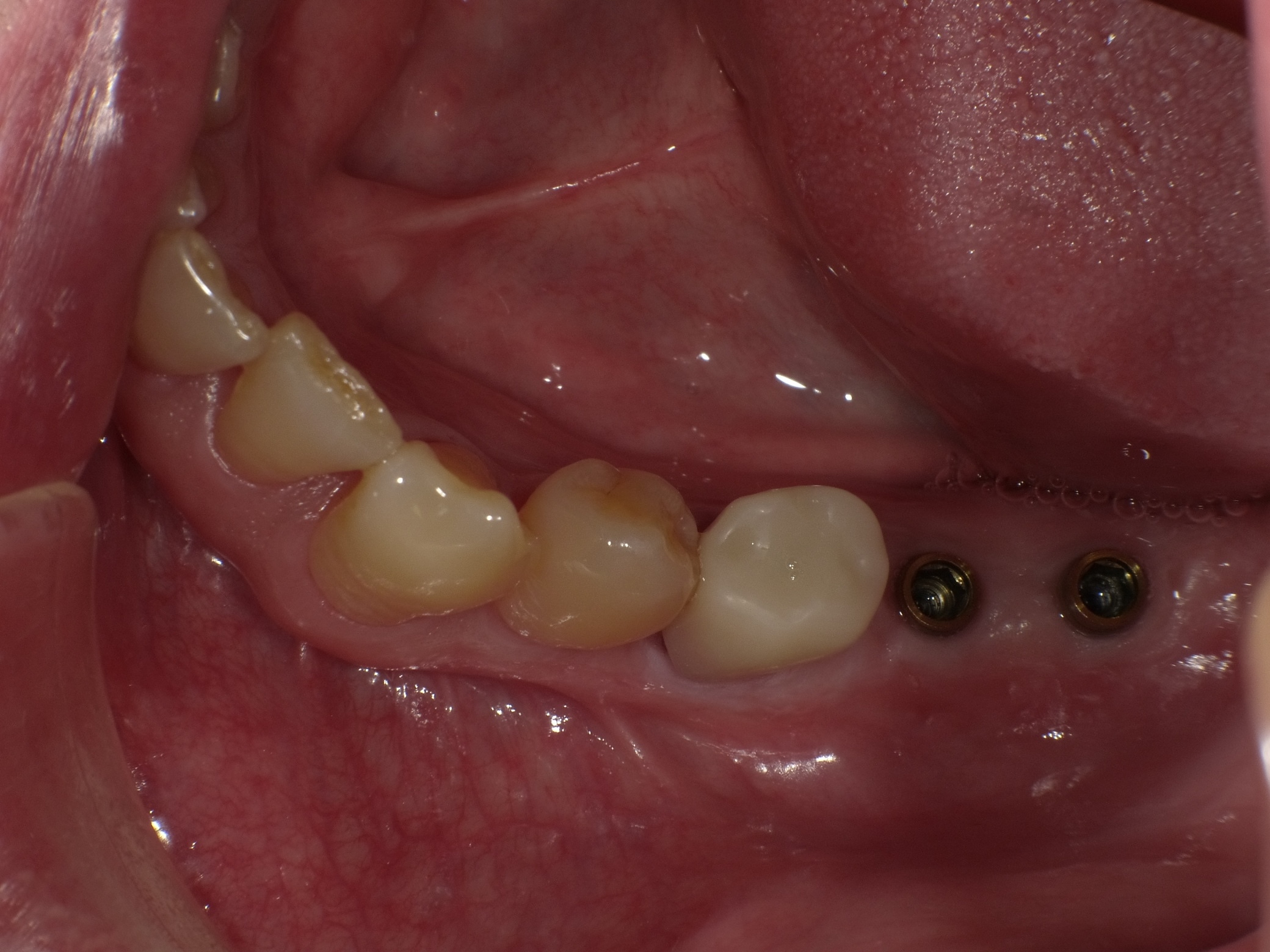 左下２本インプラント症例 image 3