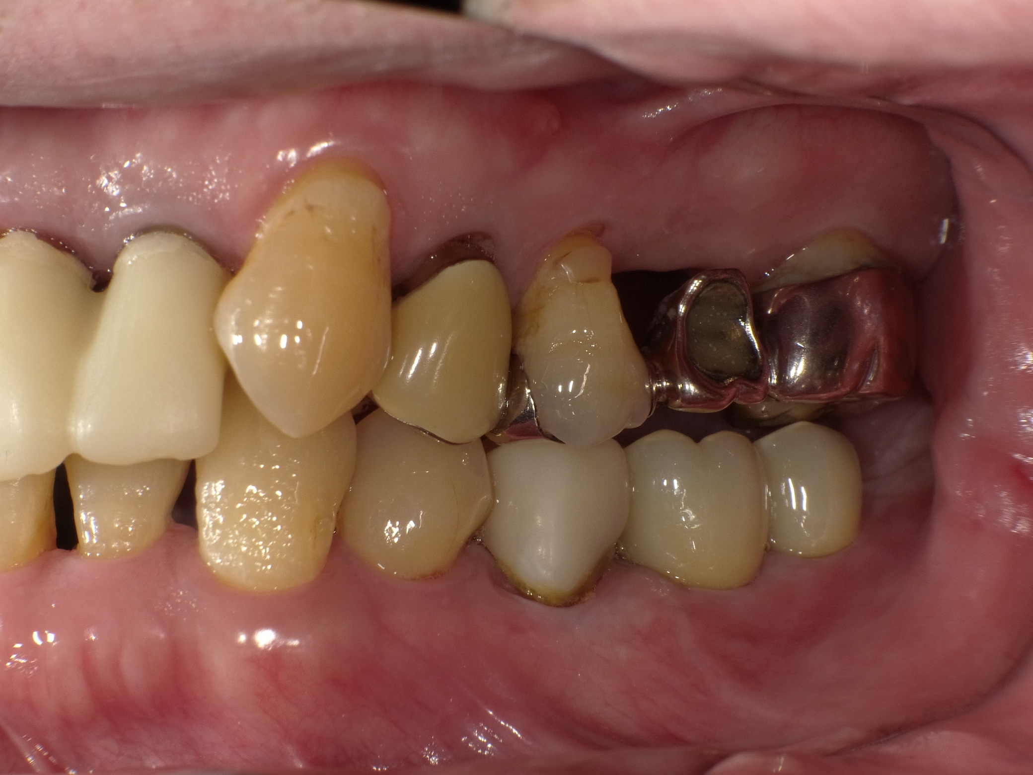 左下２本インプラント症例 image 5