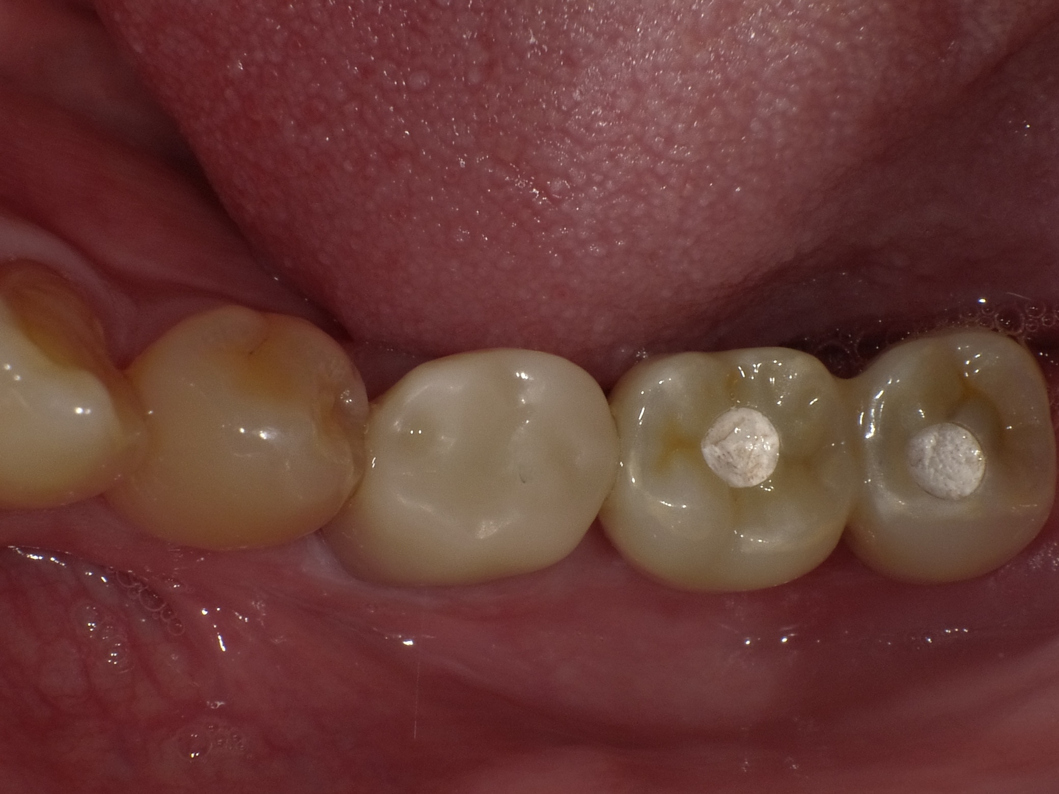左下２本インプラント症例 image 4