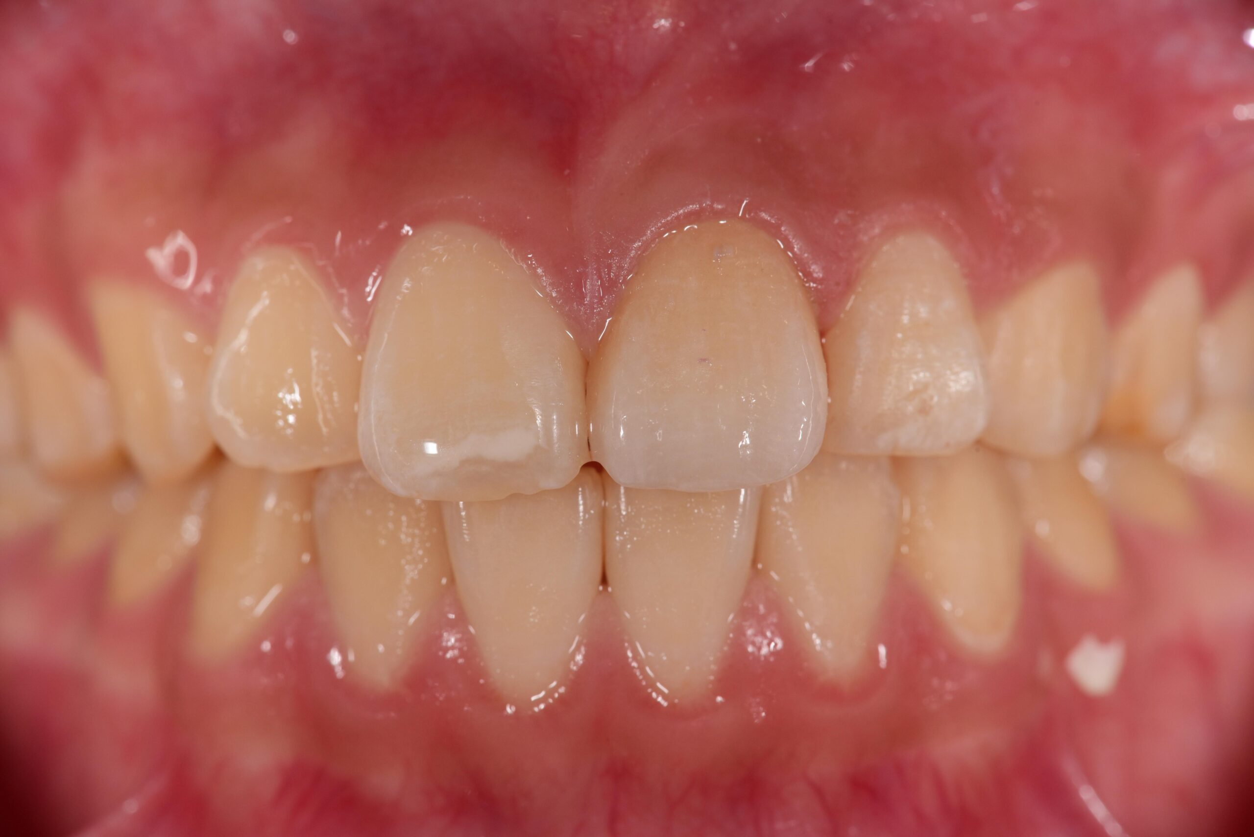 左上前歯ポーセレンフルジルコニア症例 image 2