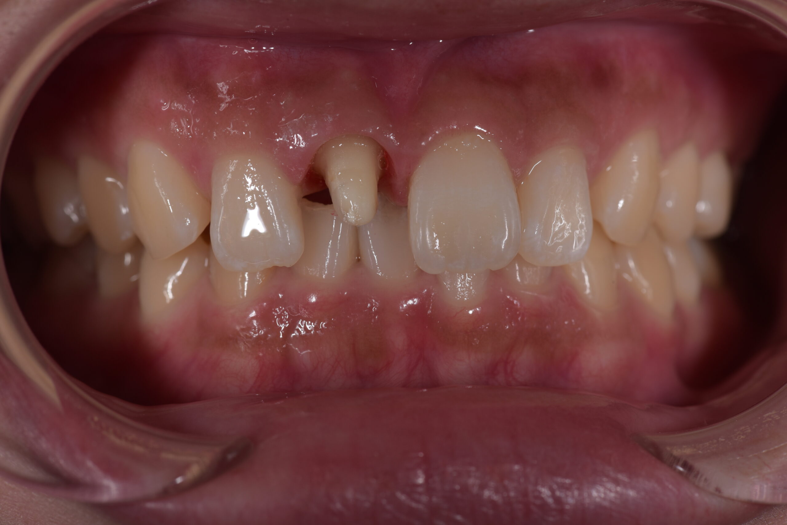 右上前歯ジルコニアクラウン症例 image 1