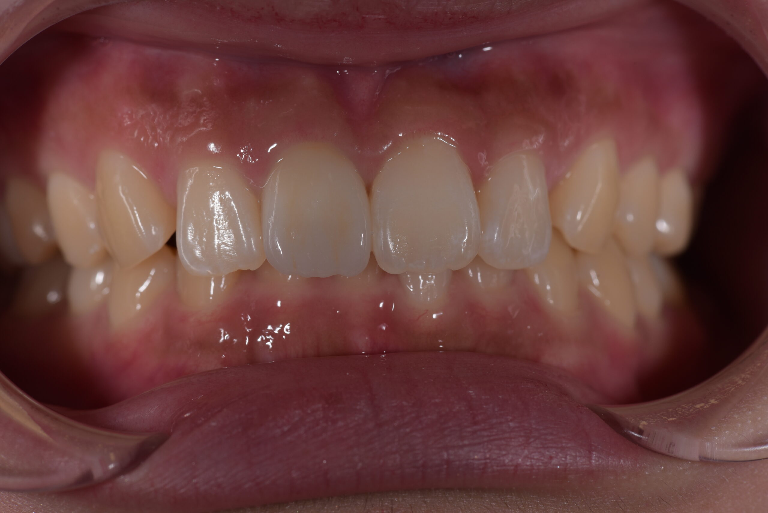 右上前歯ジルコニアクラウン症例 image 2