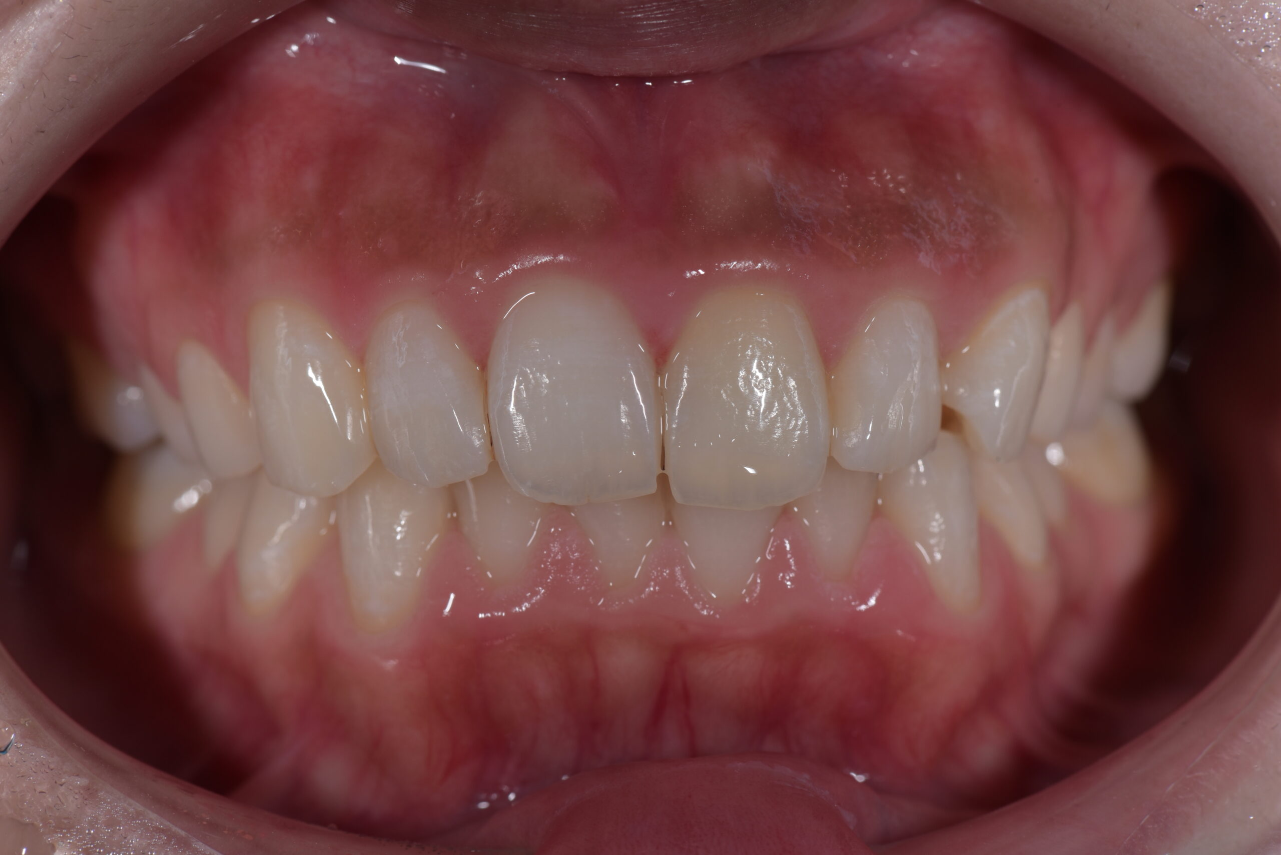 左上前歯ポーセレンフルジルコニア症例 image 1