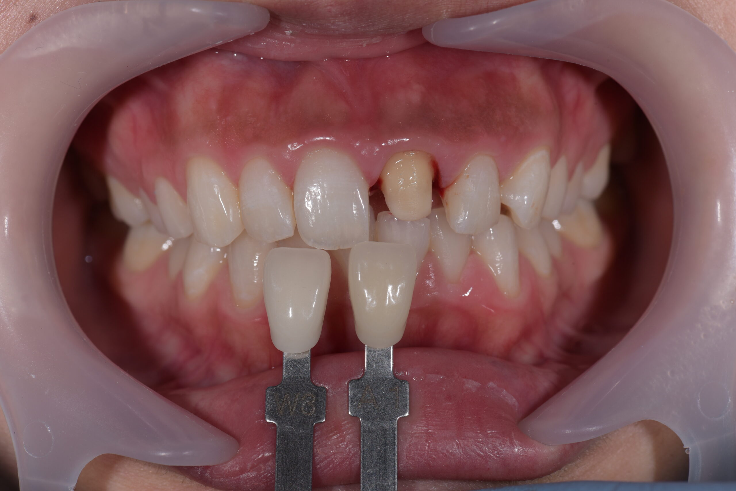 左上前歯ポーセレンフルジルコニア症例 image 2