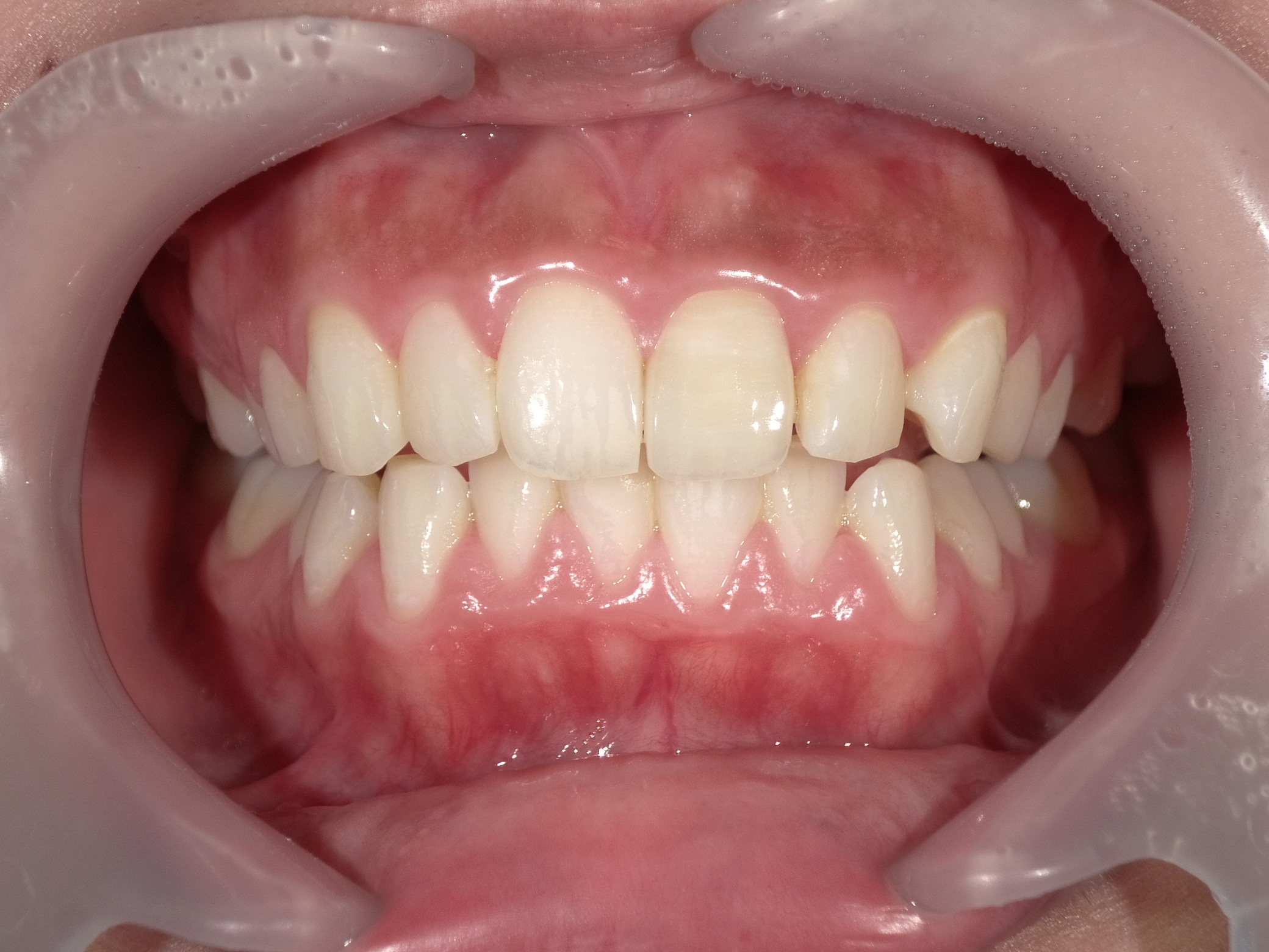 左上前歯ポーセレンフルジルコニア症例 image 3