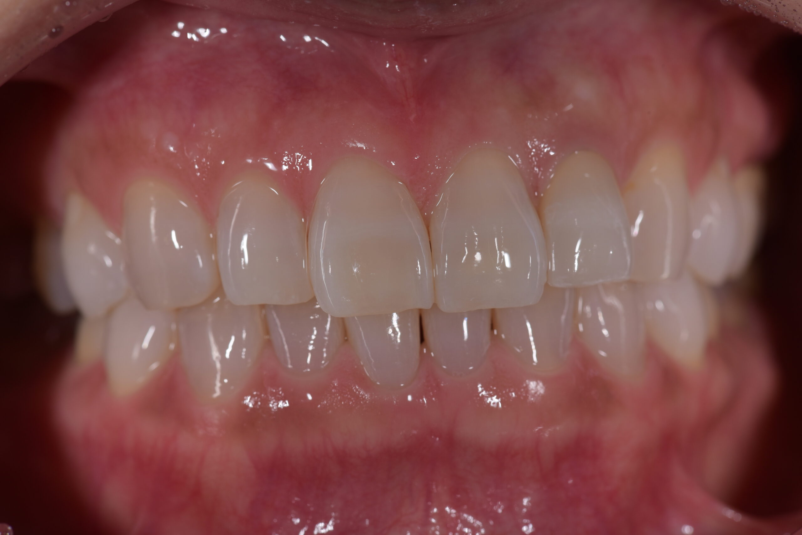 左上前歯ポーセレンフルジルコニア症例 image 3