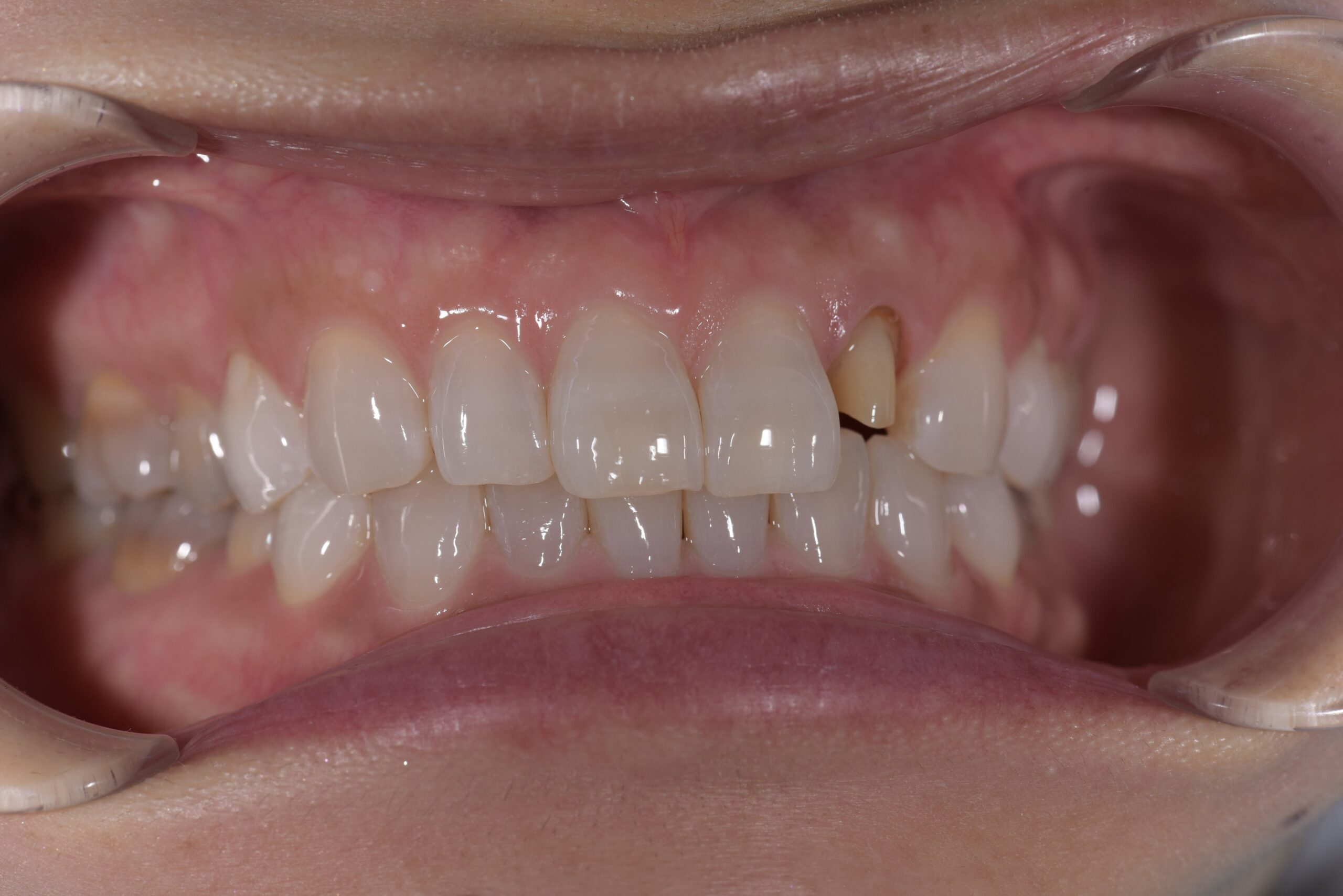 左上前歯ポーセレンフルジルコニア症例 image 2