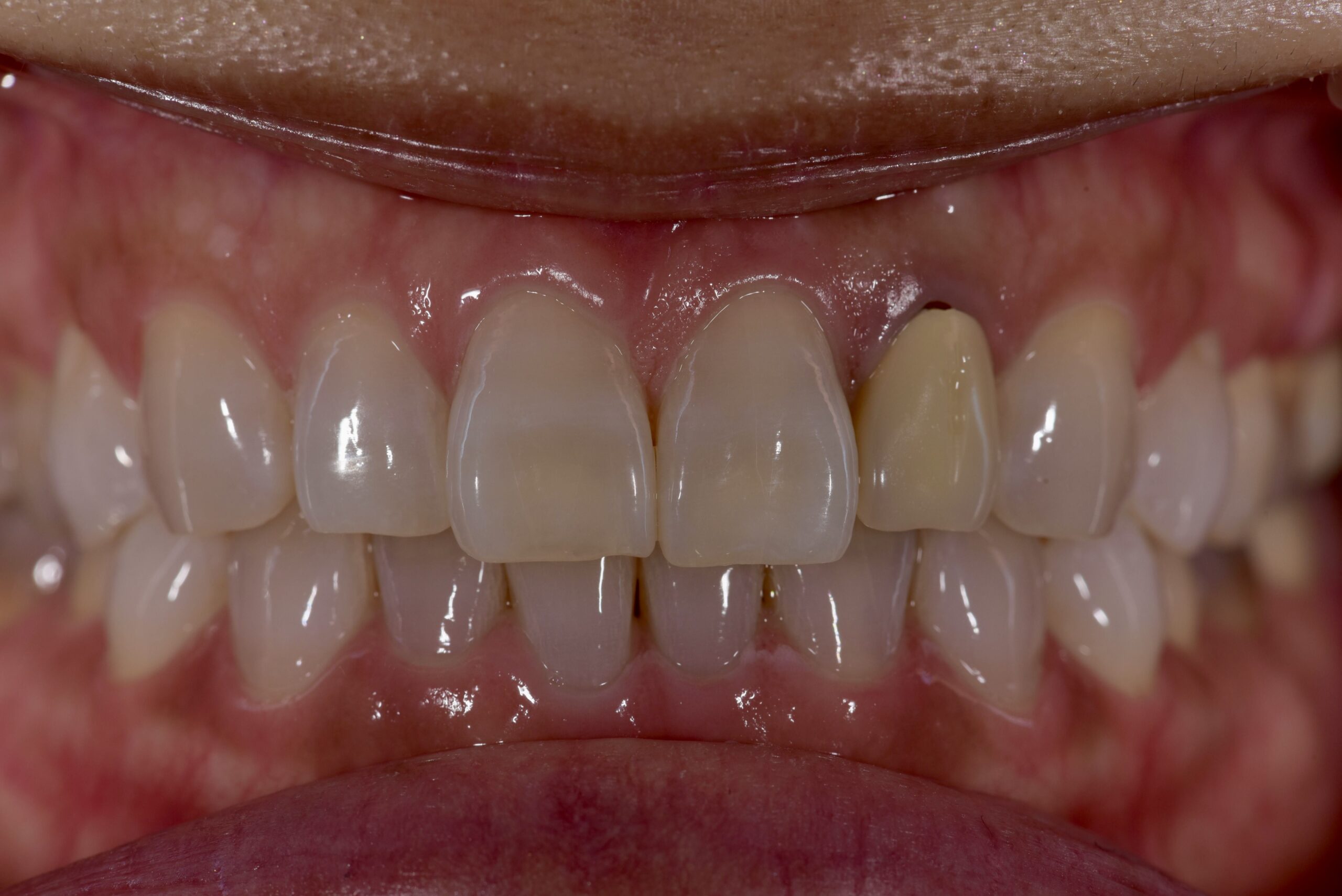 左上前歯ポーセレンフルジルコニア症例 image 1