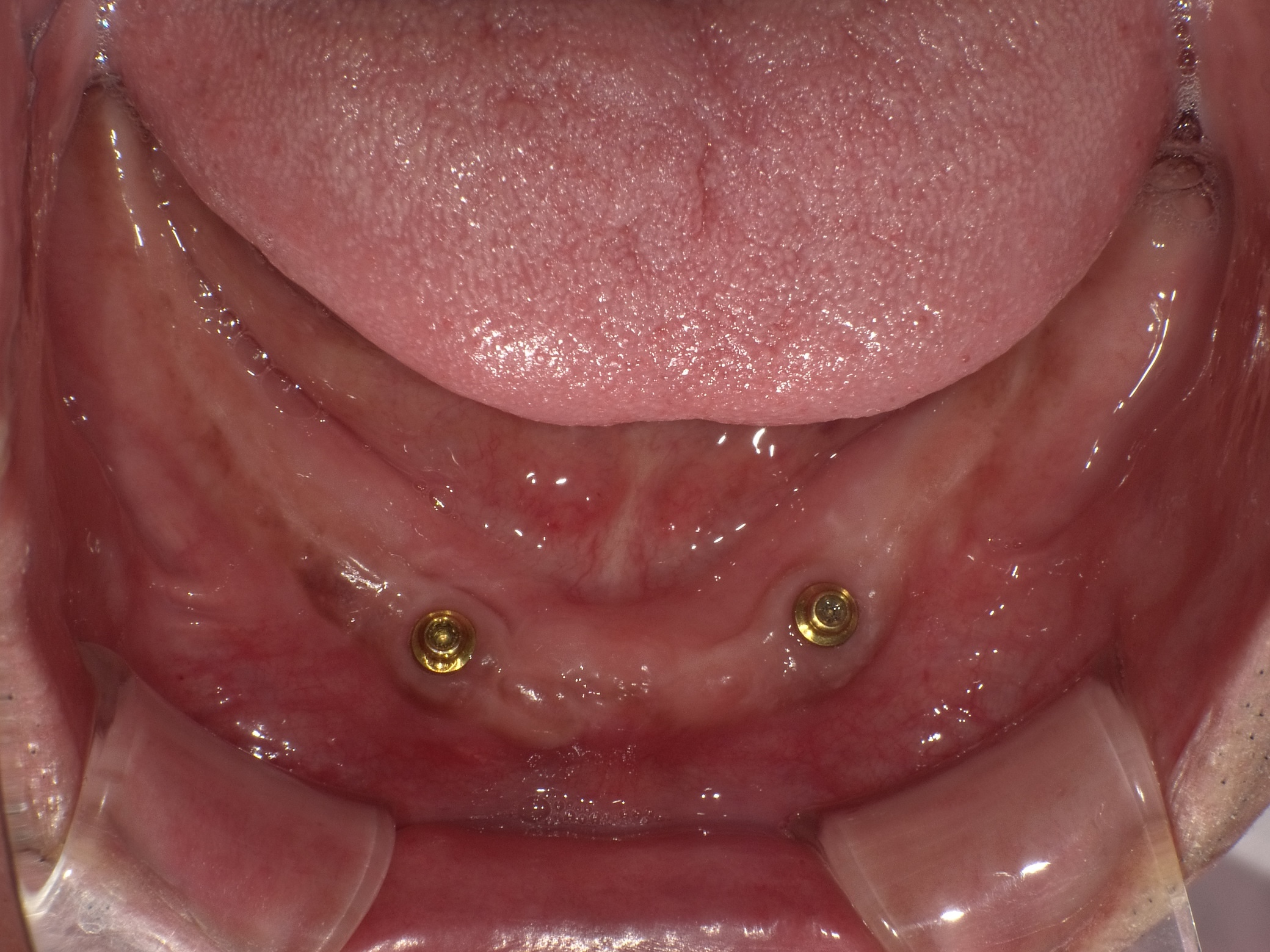 インプラントオーバーデンチャー症例 image 2