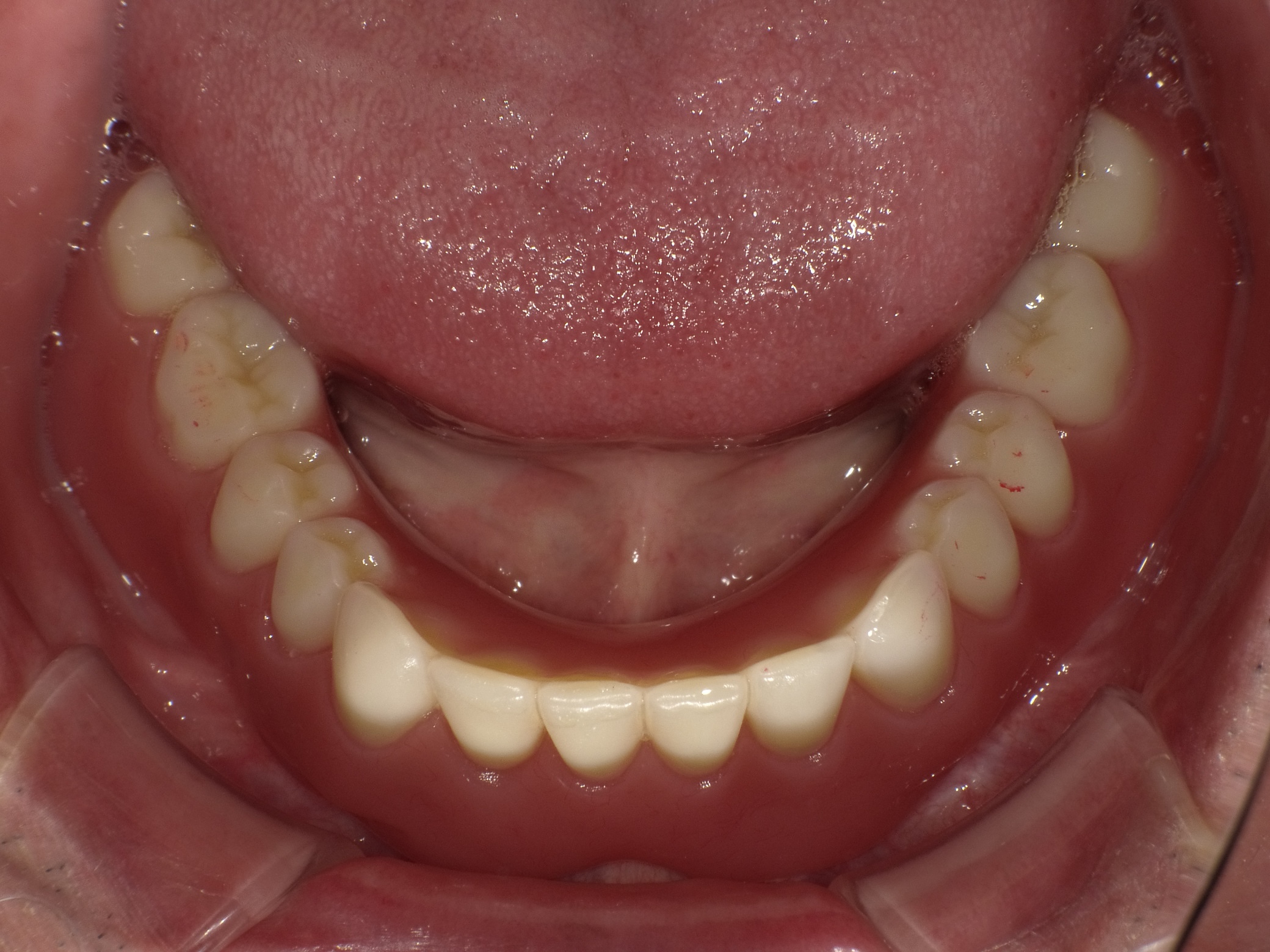 インプラントオーバーデンチャー症例 image 4