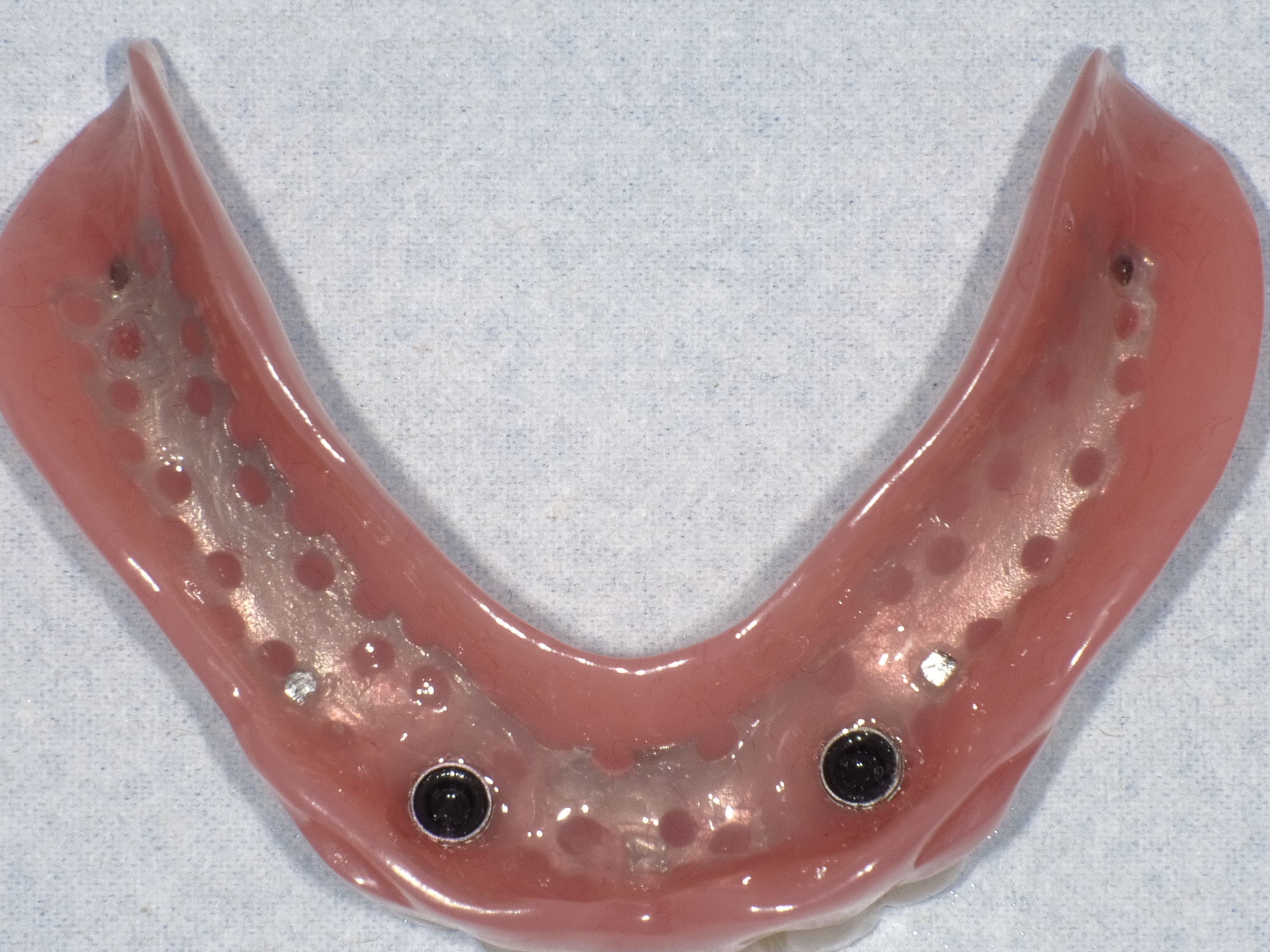 インプラントオーバーデンチャー症例 image 3