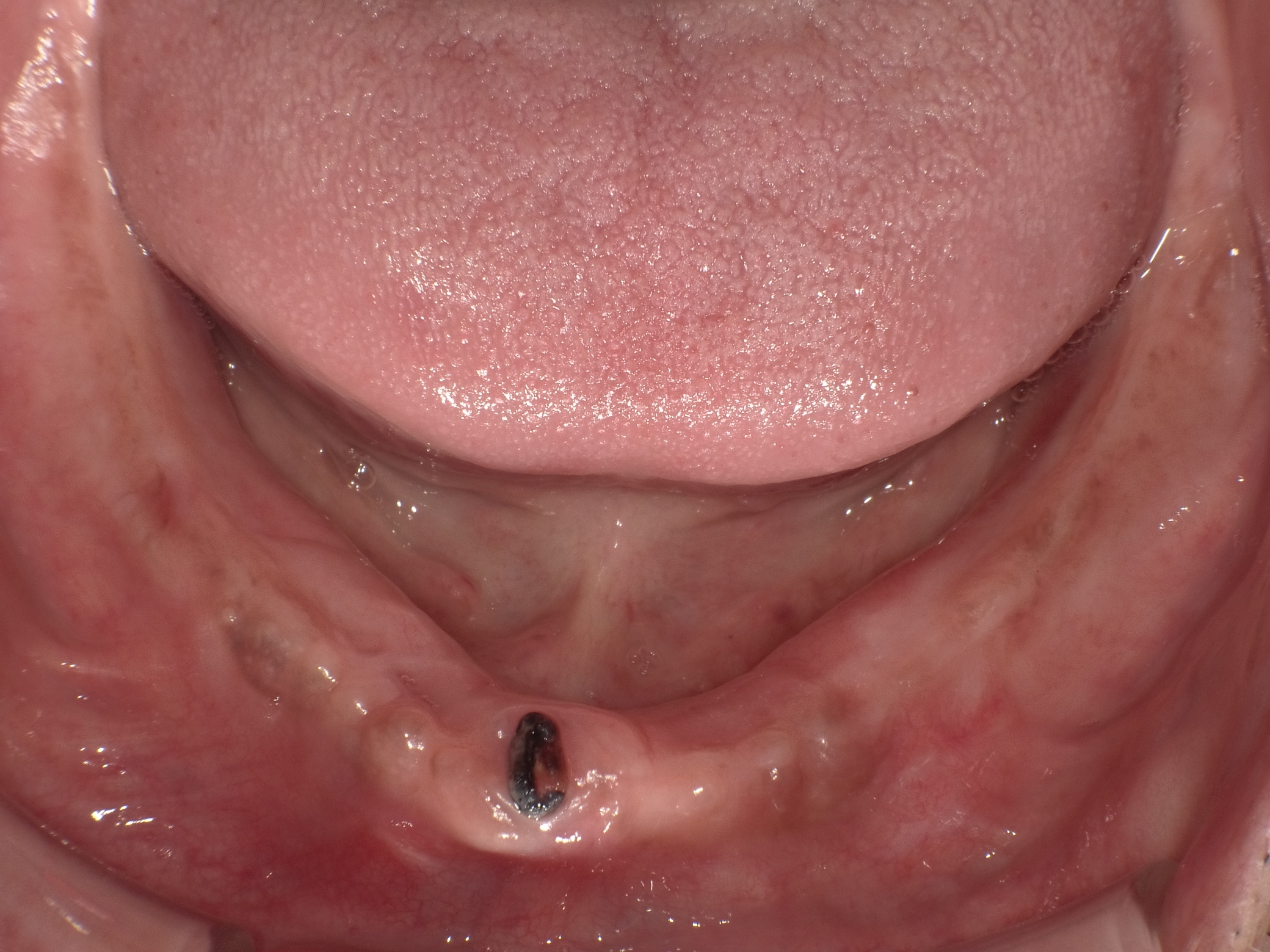 インプラントオーバーデンチャー症例 image 1